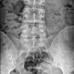 Ortopedia Lumbar